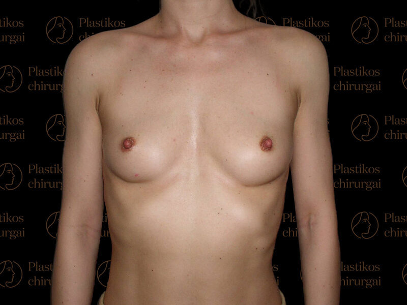 Krūtų didinimas implantais